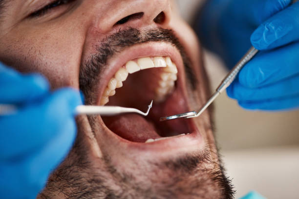 Best Emergency Wisdom Teeth Removal in Pacheco, CA
